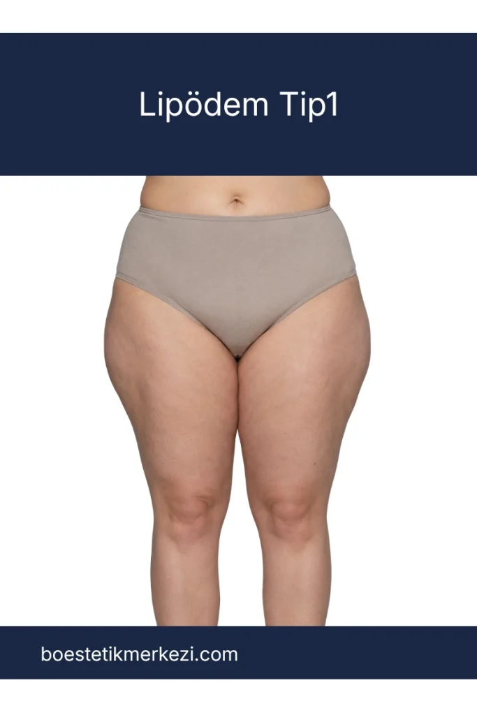 Lipödem tip 1 kalça pelvis bölgesi yağ dağılımı