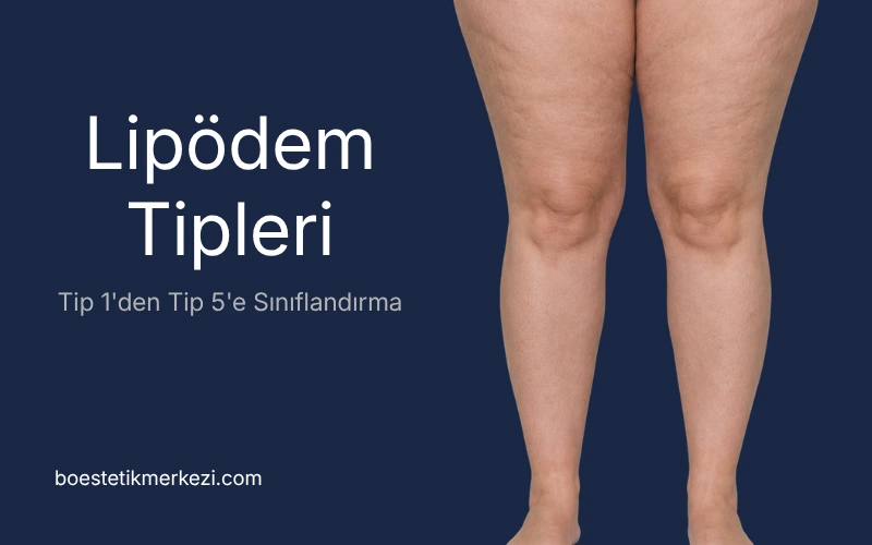 Lipödem Tipleri Tip 1'den Tip 5'e Sınıflandırma
